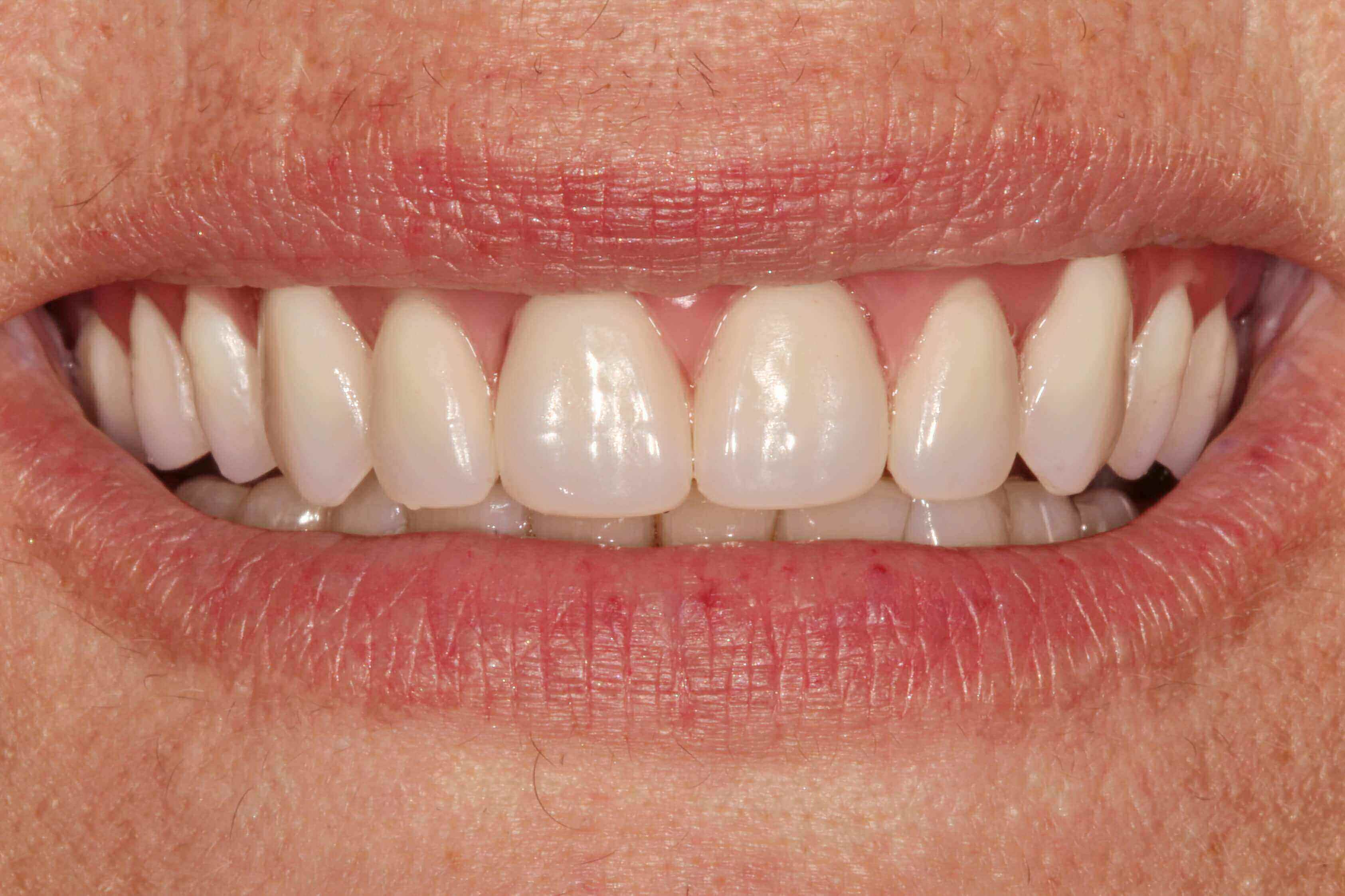 Image of teeth after treatment