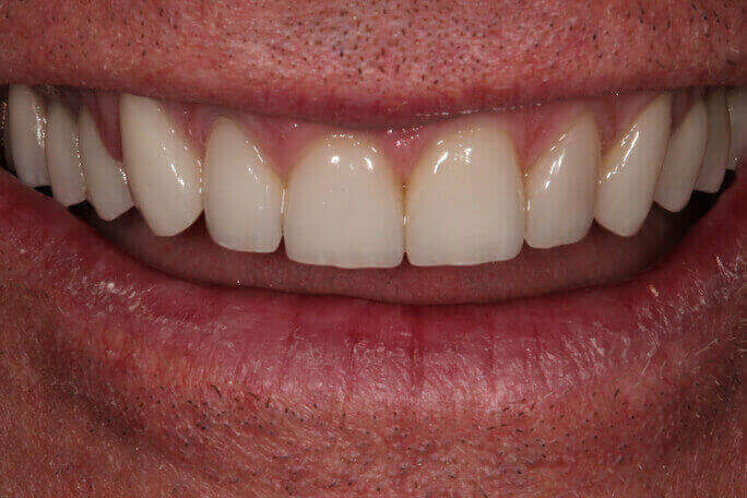 Image of teeth after treament